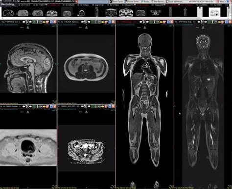 Full Body Mri Scan Nuceria Health Miami Fl