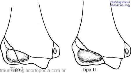 Classificação De Milch Traumatologia E Ortopedia