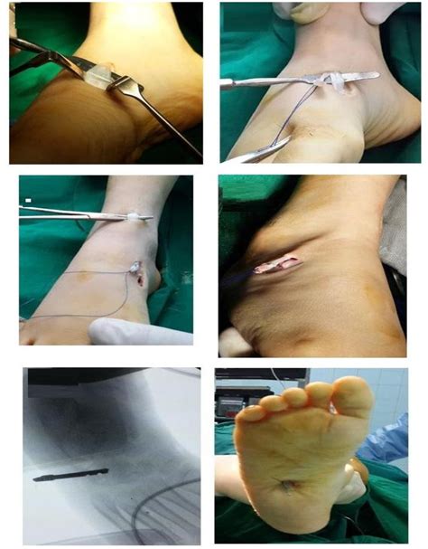 Figure 1 From Role Of Tibial Anterior Tendon Transfer Total Or Split In Role Of Tibial Anterior