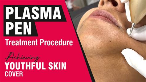 Plasma Pen Treatment Procedure Achieving Youthful Skin Youtube