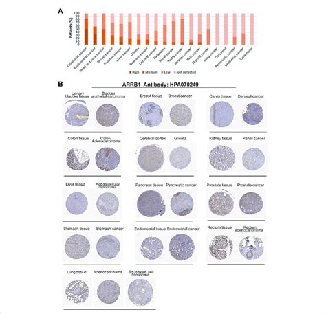 Expression Of Arrb Protein In Various Cancer Tissues In The Hpa