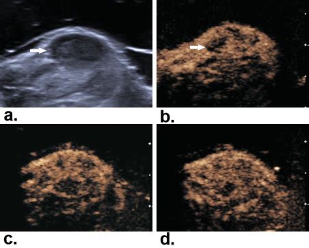 Characteristic Blood Perfusion Reduction Of Walker Tumor Induced By