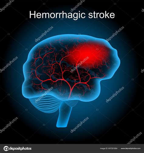 Descargar Derrame cerebral hemorrágico hemorragia intracerebral y