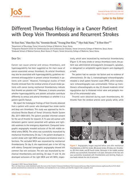 (PDF) Different Thrombus Histology in a Cancer Patient with Deep Vein ...