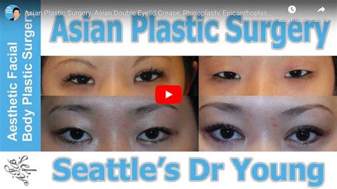 Asian Facial Plastic Surgery Seattle Bellevue