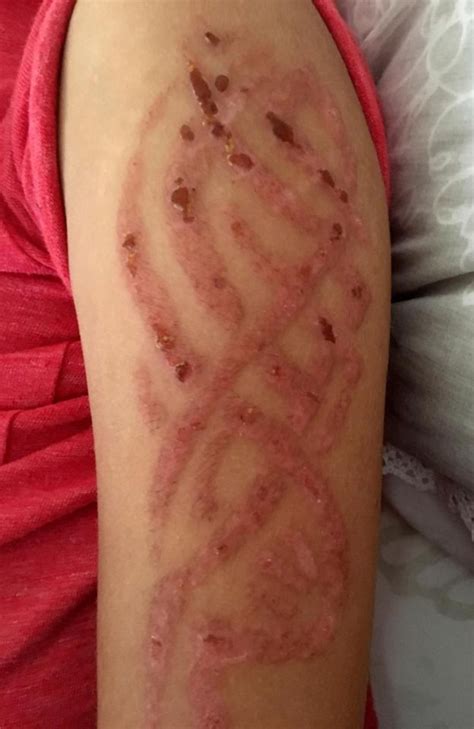 Henna Tattoo Allergic Reaction Leaves Boy 7 With Severe Burns On Arm