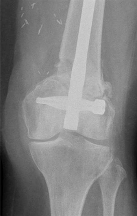 Figure From Femur Fracture Following Medial Femoral Condyle Flap