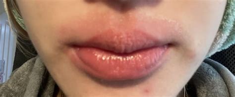 First Time My Lips Have Been Flaring Up First Time Its Been This