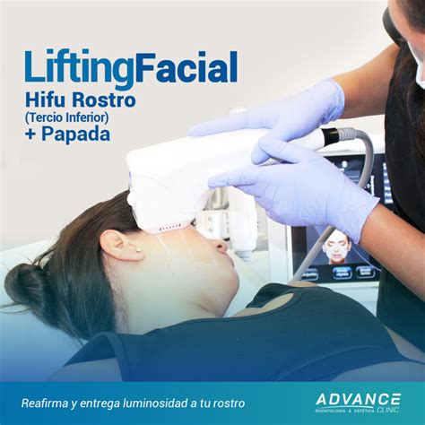 HIFU FACIAL Tercio inferior Papada Clínica Dental y Estética Viña