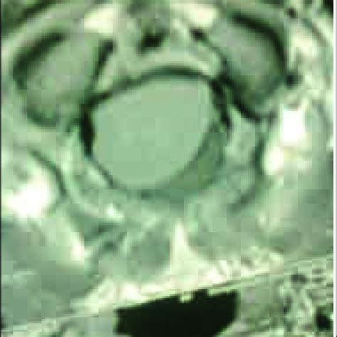 A Shows The Mri Of Cranio Cervical Junction Foramen Magnum Meningioma