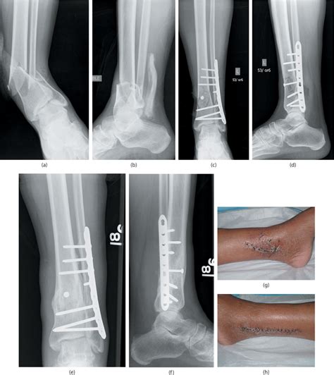 Distal Tibial Fractures Musculoskeletal Key