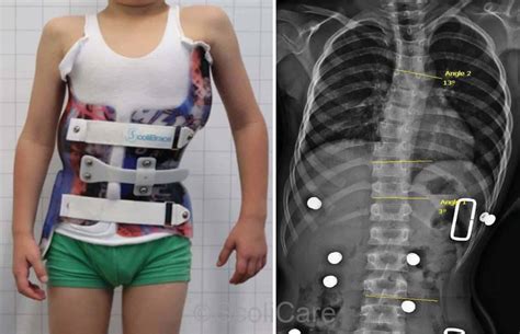 Superior in-brace correction achieved with a ScoliBrace