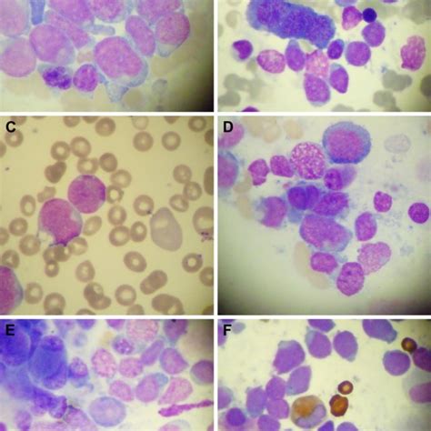 Pdf Adult Acute Megakaryoblastic Leukemia Rare Association With Cytopenias Of Undetermined