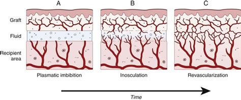 Skin Graft Healing Timeline - Infoupdate.org