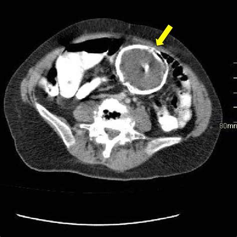 Tomograf A Computarizada De Abdomen Que Documenta Masa Intraabdominal