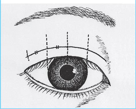 Figure 1 From Modified Double Eyelid Blepharoplasty Using The Single