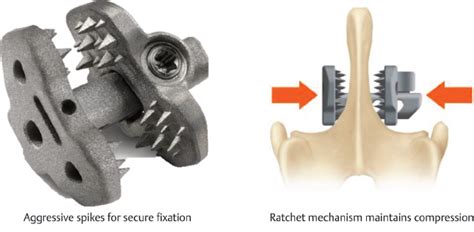 8 Spinous Process Fixation Systems | Neupsy Key