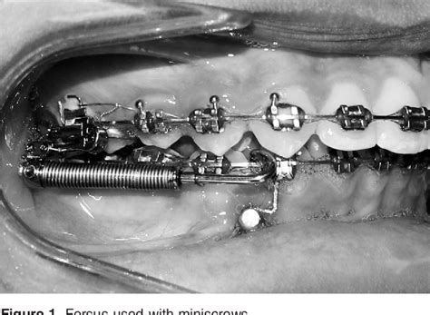 Figure 1 From Treatment Outcomes Of Class Ii Malocclusion Cases Treated