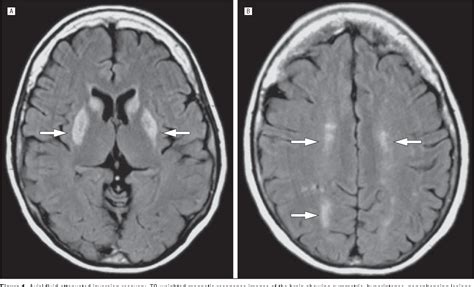 Mitochondrial Neurogastrointestinal Encephalopathy Treatment