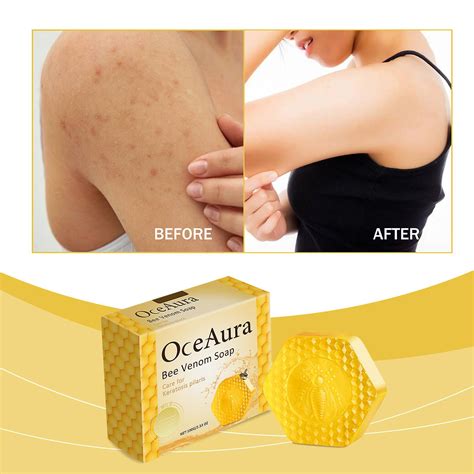 Keratosis Pilaris Bee Venom Soap, Keratosis Pilaris Soap, Keratosis