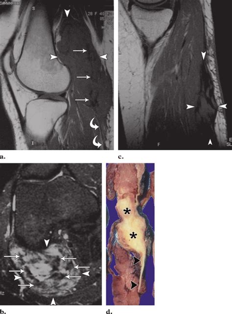 Local Recurrence Of Desmoid Type Fibromatosis Of The Popliteal Region Download Scientific