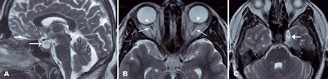 Scielo Brasil A Case Of Bilateral Fourth Nerve Palsy Associated With