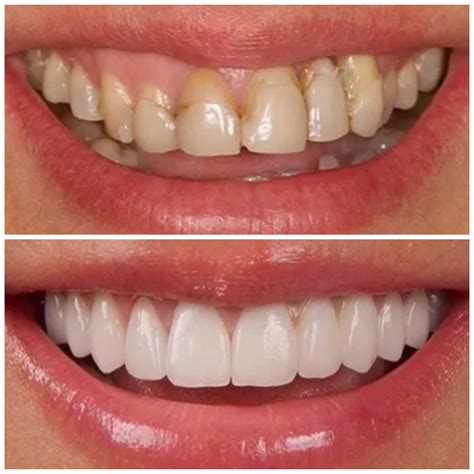 dental veneer insurance
