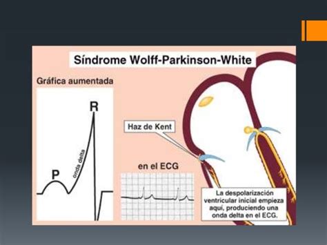 Síndrome De Wolff Parkinson White