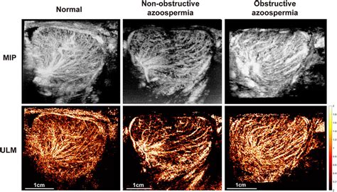 Super‐resolution Ultrasound Localization Microscopy For The Non