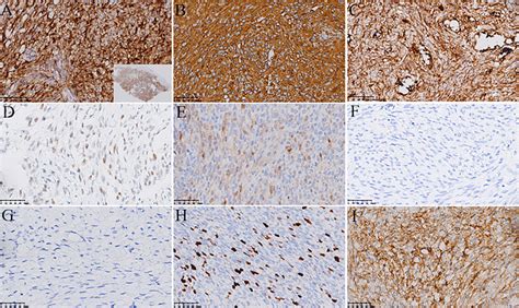 Immunohistochemistry The Tumor Is Diffusely And Strongly Positive For