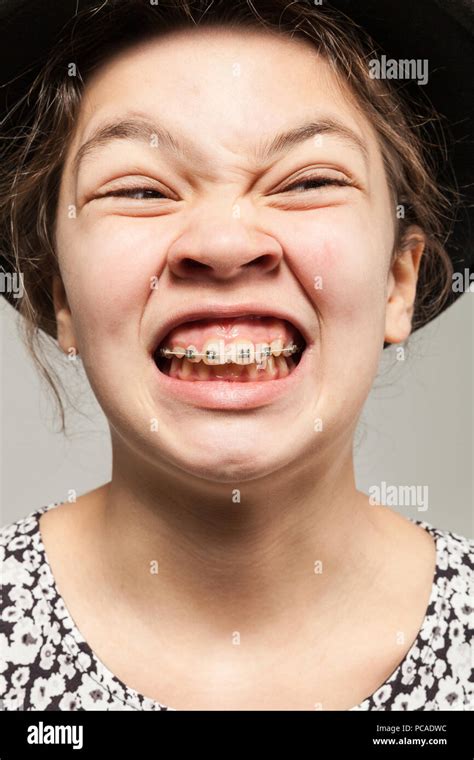 Funny girl with dental braces making grimaces Stock Photo - Alamy