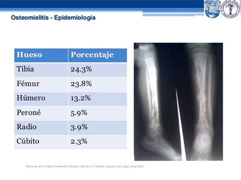 Osteomielitis Aguda Y Cronica