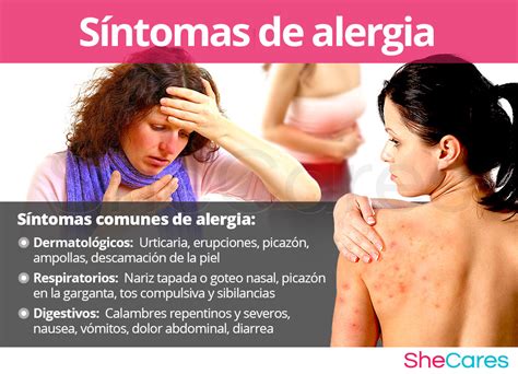 Descobrir 39 Imagem Alergia A Alecrim Sintomas Br Thptnganamst Edu Vn