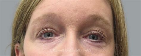 Brow Lift Case Faces Pllc In Ridgeland Ms