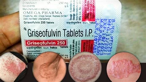 Griseofulvin 250 Mg Tablets Uses In Hindi Griseofulvin Tablet