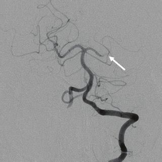 (PDF) A Case of Acute Isolated Posterior Cerebral Artery Occlusion ...