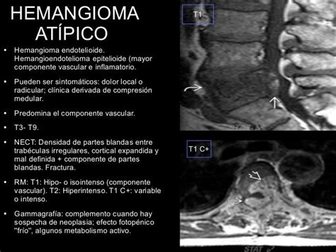 Revisión De Tema Hemangioma Vertebral