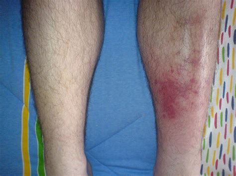 Celulitis Infecciosa Síntomas Diagnostico Prevención y Tratamientos