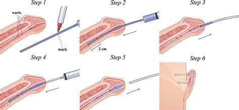 Topical 5 Aminolevulinic Acid Photodynamic Therapy With Novel Approach Successfully Treated