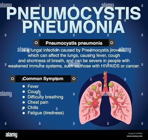 Informative Poster Of Pneumocystis Pneumonia Illustration Stock Vector Image And Art Alamy