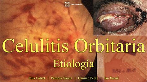 Celulitis Orbitaria Etiolog A Youtube