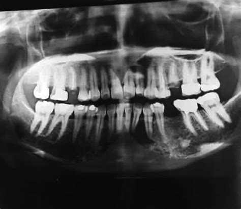 Initial Orthopantomography Opg Showing A Unilocular Radiolucent