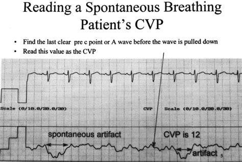 Pulmonary Artery Waveform Analysis