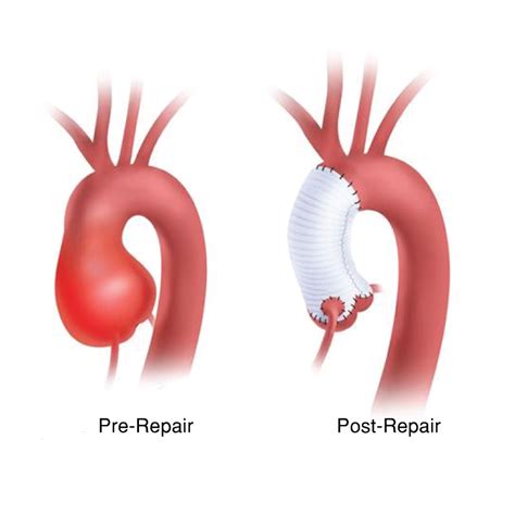 Aortic Aneurysm Symptoms And Repair Role Of Axiostat