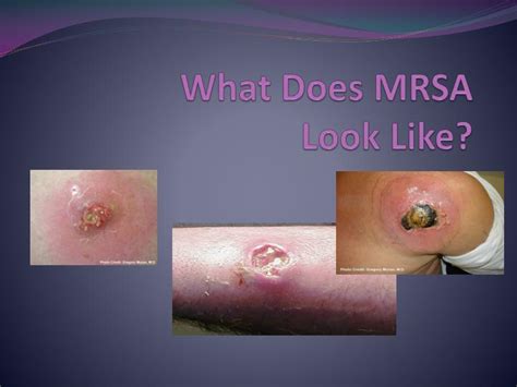 Ppt Mrsa Prevention And Care Methicillin Resistant Staphylococcus Aureus Powerpoint Presentation