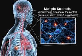 Uso Delle Cellule Mesenchimali Da Tessuto Cordonale Per La Sclerosi