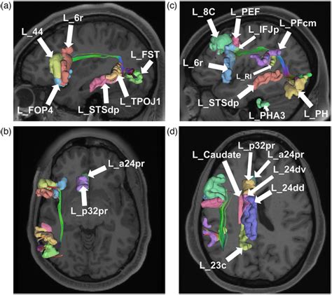 Tractographic model of areas fundus of the superior temporal sulcus (a,... | Download Scientific ...