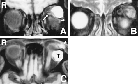 Figure 1 From Orbital Dermoid Cyst With Intratumoral Inflammatory