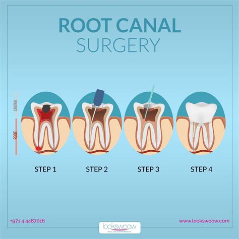 Root Canal Step By Step