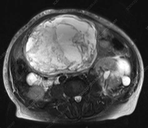 Gastrointestinal Stromal Tumour Mri Stock Image C